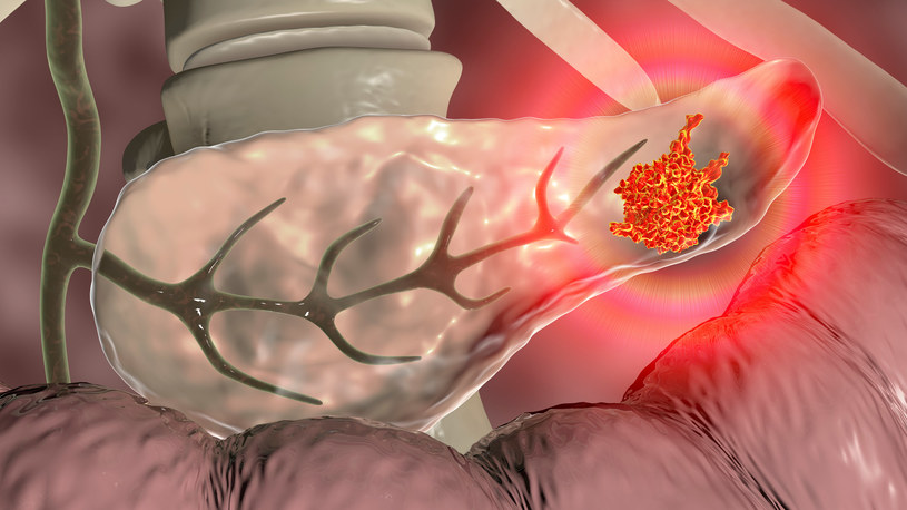 Ból brzucha i wzdęcia to wczesne objawy nowotworu trzustki /123RF/PICSEL