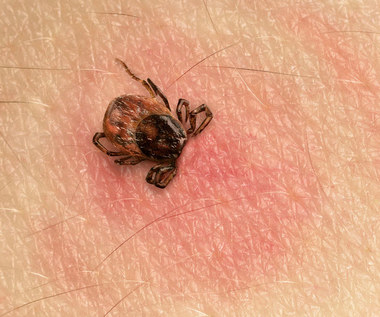 Borelioza: Objawy i dieta wspierająca leczenie