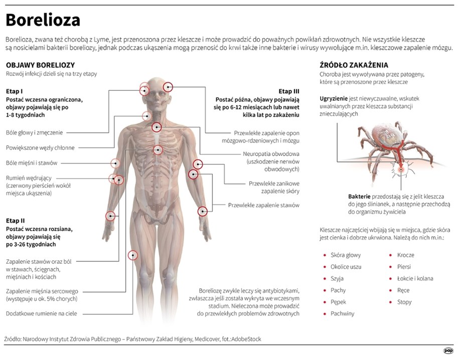 Borelioza - objawy i źródło zakażeń /Mateusz Krymski /PAP