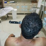 Brazylia: Mężczyzna przeżył z nożem w głowie