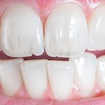 Bruksizm - czym spowodowane jest zgrzytanie zębami?