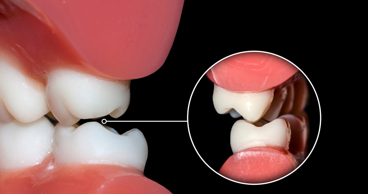 Bruksizm to powszechne zjawisko. Skąd się bierze? /123RF/PICSEL