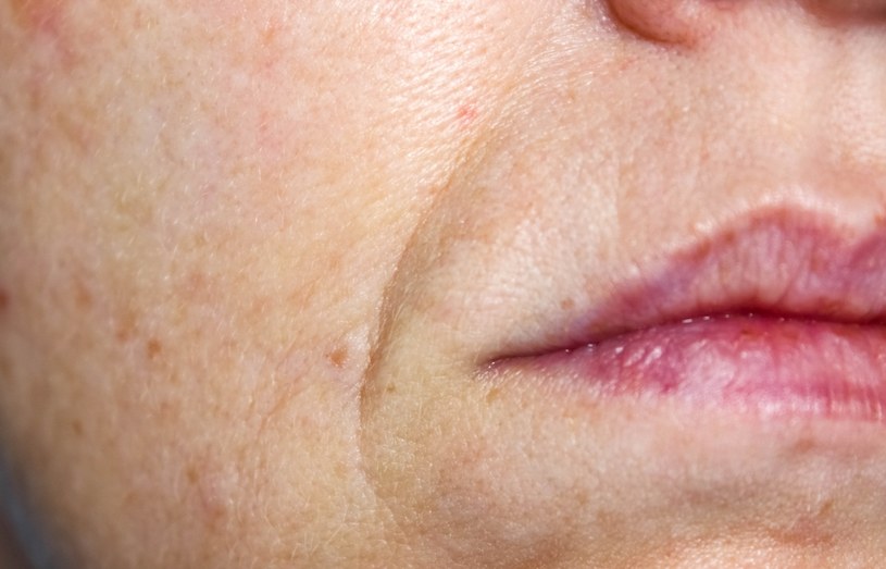 Bruzdy nosowo-wargowe często pojawiają się u osób, regularnie sięgających po alkohol /123RF/PICSEL