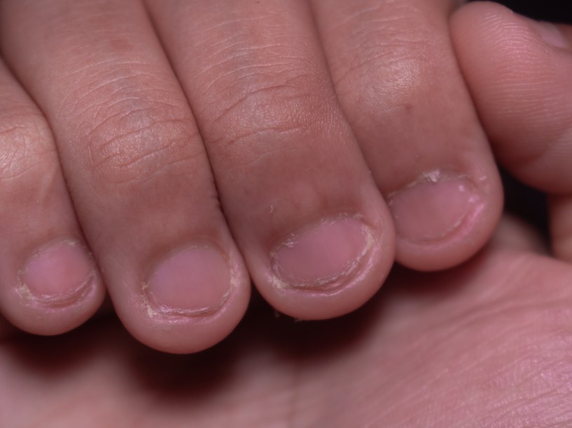 By pozbyć się problemu obgryzania paznokci, warto skonsultować się ze specjalistą i rozważyć terapię behawioralną /123RF/PICSEL