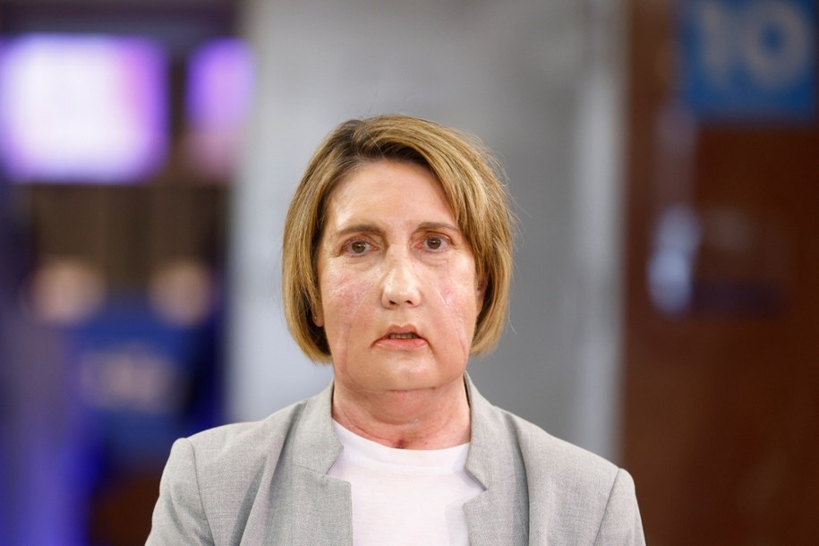 Carmen - kobieta, która dostała nową twarz po eutanazji dawczyni /Quique Garcíia  /PAP/EPA