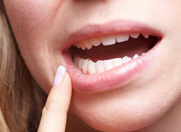 Charakterystyczne pęknięcia w kącikach ust świadczą o stanie zapalnym /123RF/PICSEL