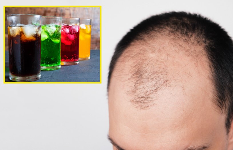 Chińscy naukowcy zdobyli nowe poszlaki, mówiące, że słodkie napoje mogą powodować łysienie u mężczyzn