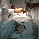 Chirurdzy wydobyli z żołądka kobiety 152 metalowe przedmioty
