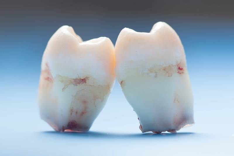 Nastolatkowi usunięto aż 232 zęby!