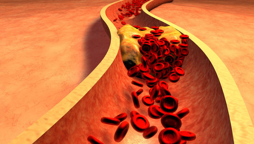 Cholesterol - jedna z przyczyn niewydolności serca /123RF/PICSEL