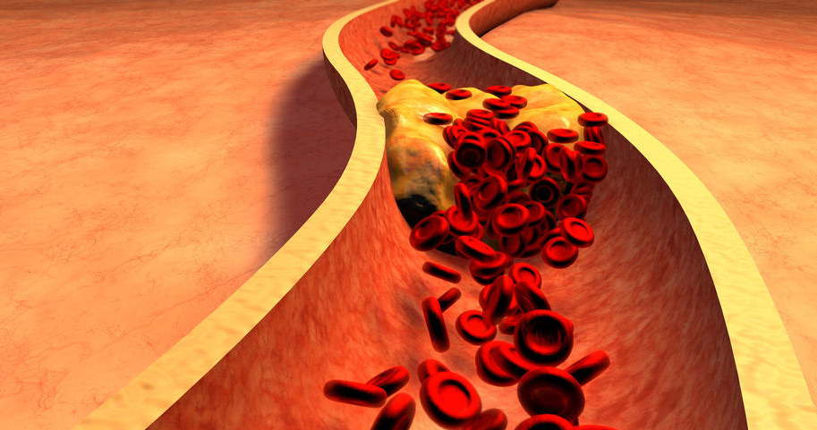 Cholesterol - jedna z przyczyn niewydolności serca /123RF/PICSEL