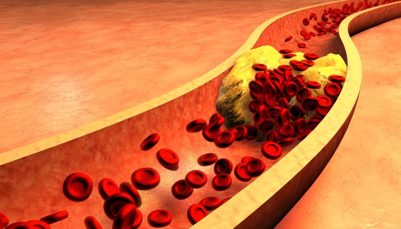 Cholesterol LDL powstaje w wyniku przemian lipoprotein VLDL produkowanych w wątrobie oraz chylomikronów powstających w wyniku wchłaniania tłuszczów pokarmowych /123RF/PICSEL