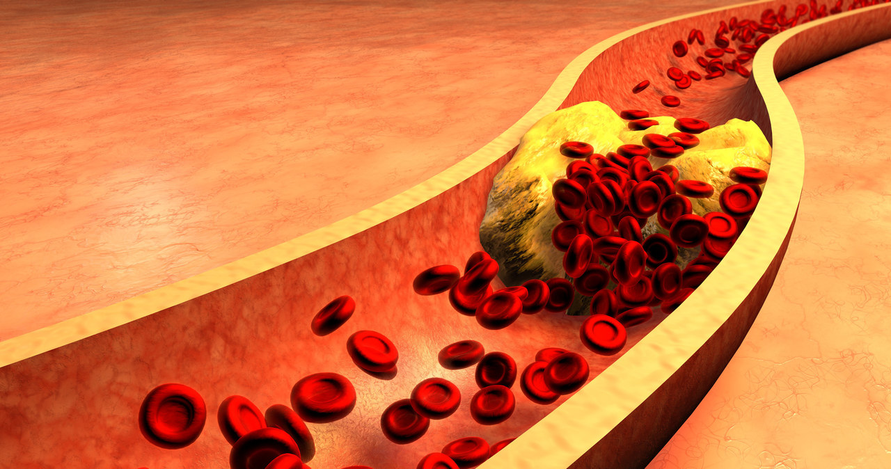 Cholesterol LDL powstaje w wyniku przemian lipoprotein VLDL produkowanych w wątrobie oraz chylomikronów powstających w wyniku wchłaniania tłuszczów pokarmowych /123RF/PICSEL