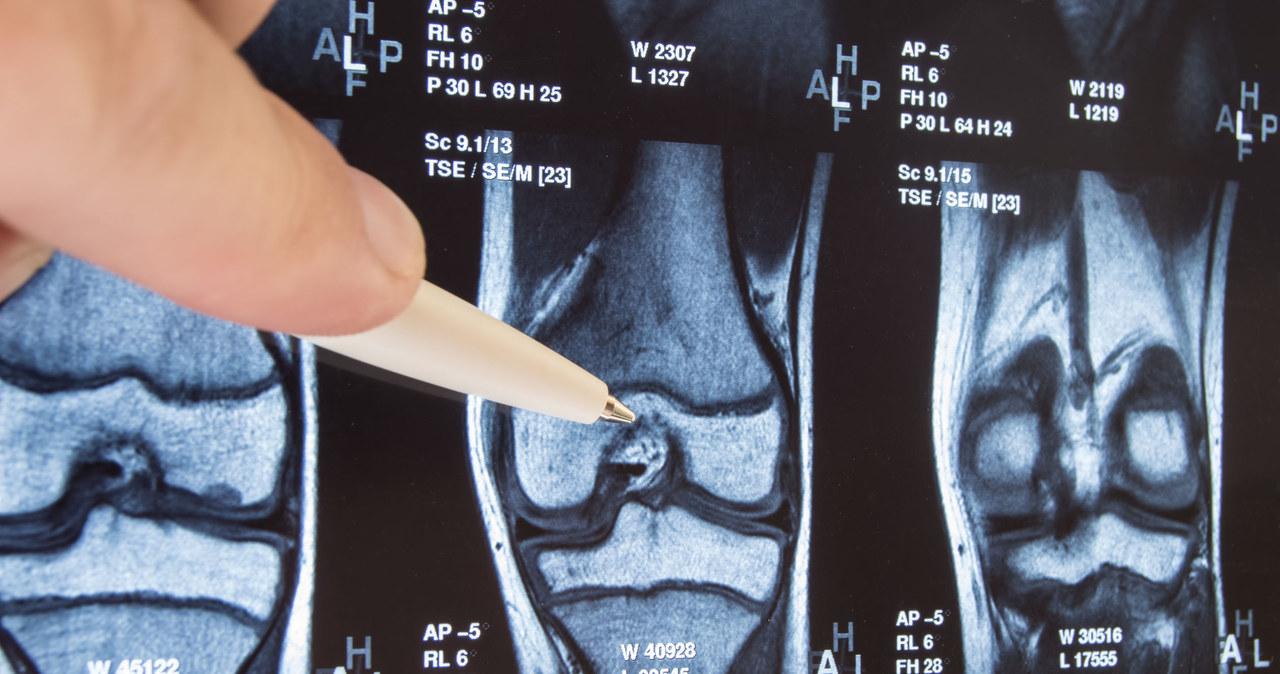 Chondromalacja polega na rozmiękczaniu chrząstki stawowej /123RF/PICSEL