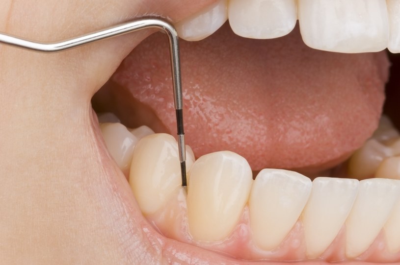 Chore zęby mogą powodować różne choroby. Sprawdź jakie. /123RF/PICSEL