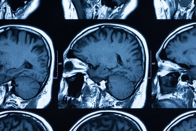 Choroba Alzheimera nazywana jest też "przedstarczym zanikiem mózgu" /123RF/PICSEL