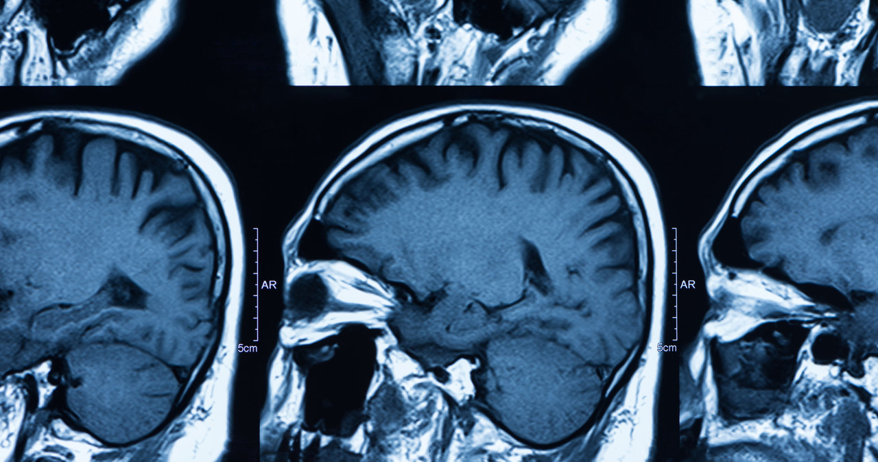 Choroba Alzheimera nazywana jest też "przedstarczym zanikiem mózgu" /123RF/PICSEL