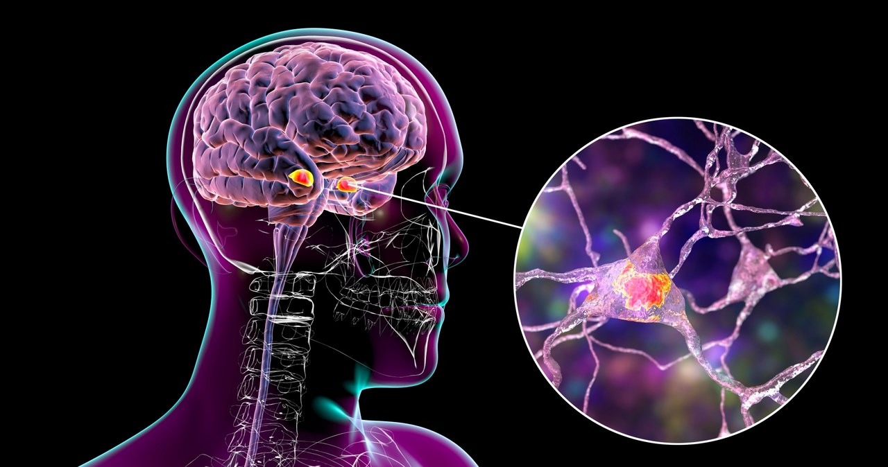 Choroba Alzheimera to najczęstsza postać otępienia, nieuleczalna i postępująca choroba neurodegeneracyjna /123RF/PICSEL