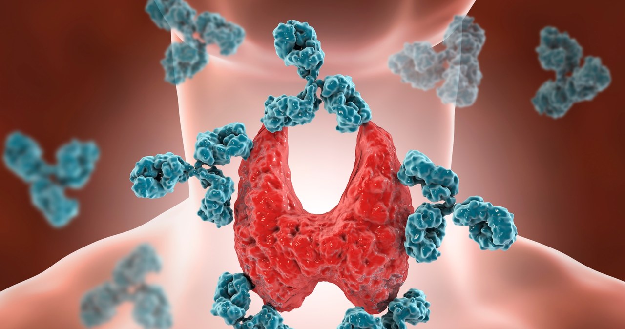 Choroba hashimoto to przyczyna blisko 90 proc. przypadków niedoczynności tarczycy /123RF/PICSEL