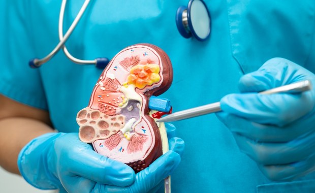 Choroba nerek, która zagraża życiu. Dotyczy blisko 5 mln osób w Polsce
