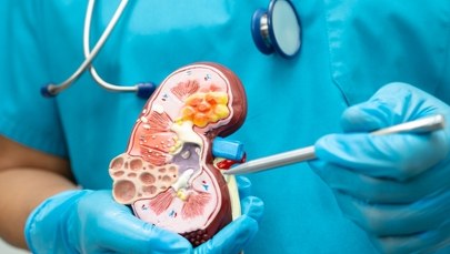 Choroba nerek, która zagraża życiu. Dotyczy blisko 5 mln osób w Polsce