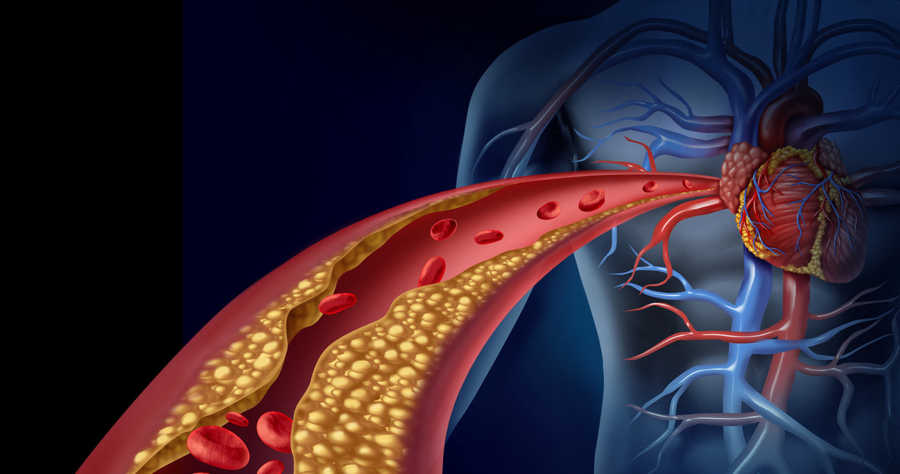 Choroba niedokrwienna serca spowodowana jest głównie przez zmiany miażdżycowe w naczyniach wieńcowych /123RF/PICSEL