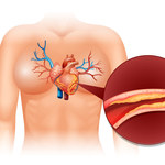 Choroba wieńcowa: Przyczyny, objawy i leczenie