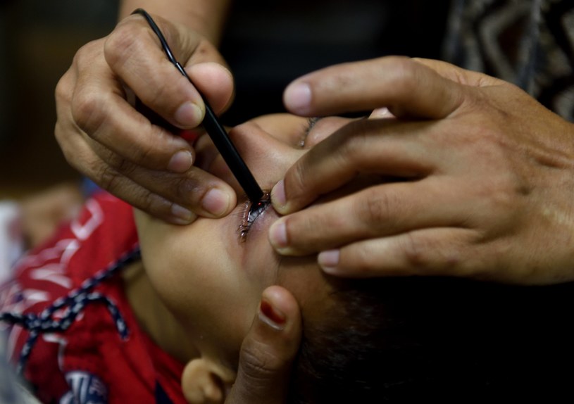 Choroba zwana "czarnym grzybem" powoduje, że konieczne może być usunięcie oczu lub nawet kości twarzy. W Indiach zmarło na nią 300 osób /Hindusian Times /Getty Images
