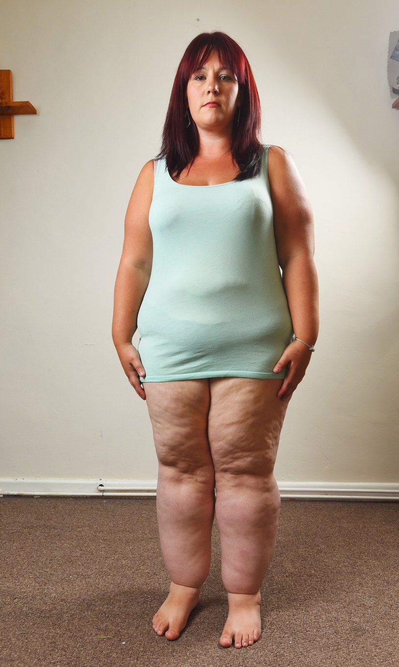 Chorobliwie zmienione partie ciała to najczęściej nogi - od kostek w górę i biodra/zdjęcie ilustracyjne /Solent News & Photo Agency /East News