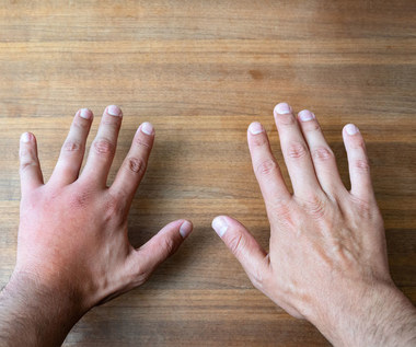 Choroby, które widać na dłoni