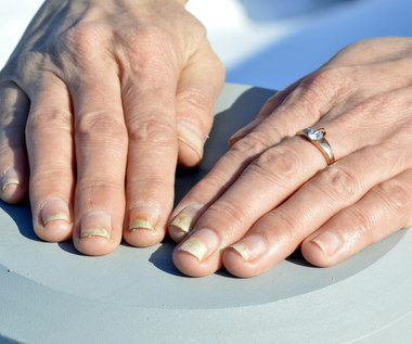 ​Choroby, które widać na paznokciach. Schorzenia paznokci
