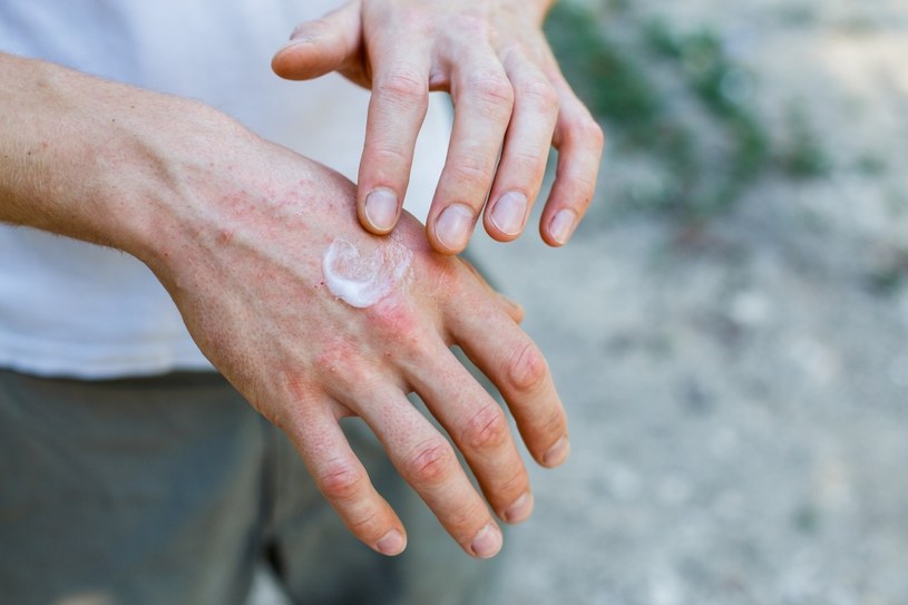 Choroby skóry mogą wymagać leczenia farmakologicznego z udziałem maści ze sterydami lub antybiotykami /123RF/PICSEL