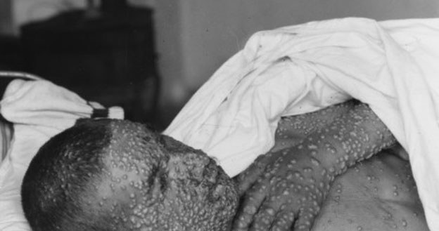Chory na ospę prawdziwą (zwaną także czarną), zdjęcie wykonane w 1920 roku /East News