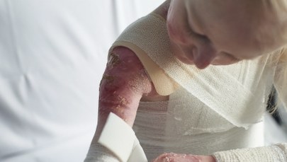 Chorzy na EB dostaną bezpłatne opatrunki. Bandaże podrożały o ponad 700 proc.