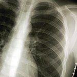 Chorzy na raka płuca alarmują: Jest problem z finansowaniem terapii