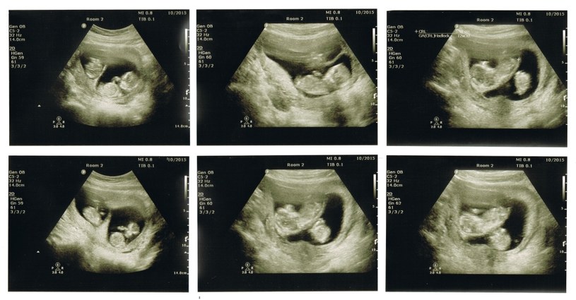 Ciąża bliźniacza zaskoczyła lekarzy /123RF/PICSEL