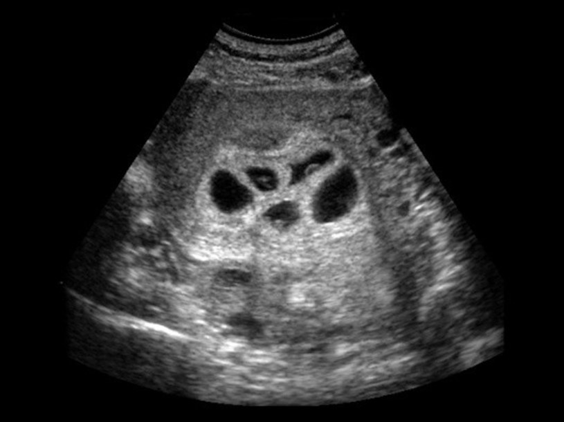 Ciąża pięcioracza zdarza się raz na... 40 960 000 ciąż! / Science Photo Library/EAST NEWS /East News