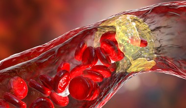 Cichy zabójca. Jak powstają i czym grożą blaszki miażdżycowe?