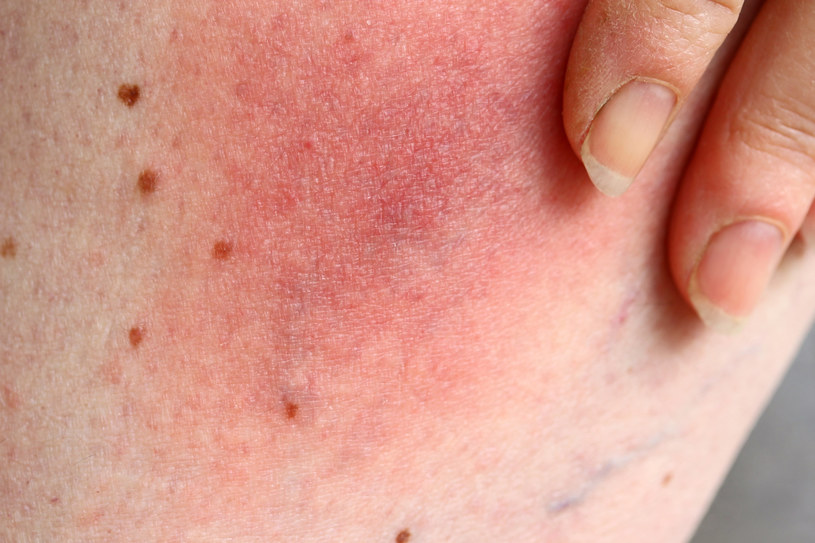 Cierpiące na dermatillomanię osoby mogą mieć na twarzy i ciele stupy, rany czy blizny, które często są odbierają im pewność siebie /123RF/PICSEL