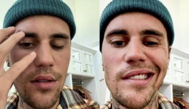 Co dolega Justinowi Bieberowi? Przyczyny, objawy i leczenie zespołu Ramsaya Hunta