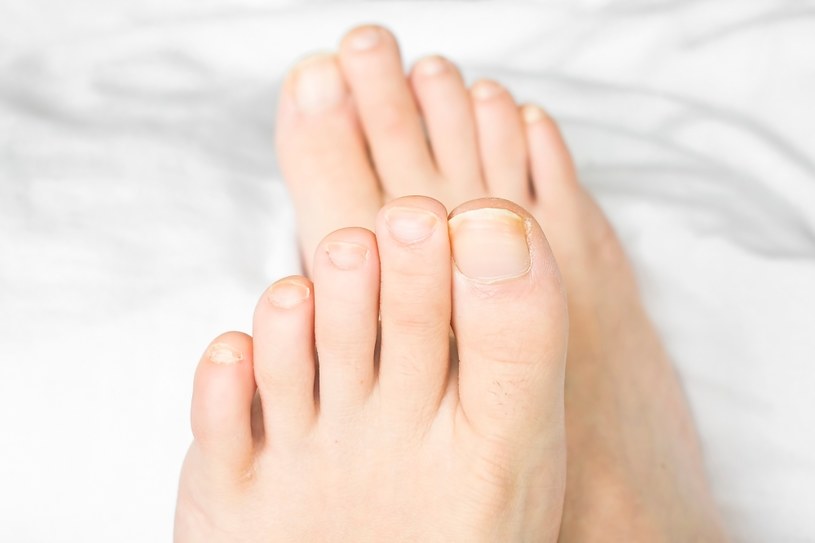 Co jest przyczyną powstawania żółtych paznokci? /123RF/PICSEL