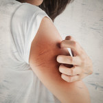Co oznacza swędzenie skóry? Objawy groźnych schorzeń