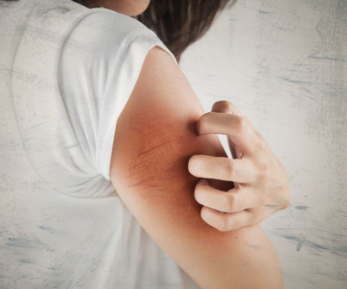Co oznacza swędzenie skóry? Objawy groźnych schorzeń