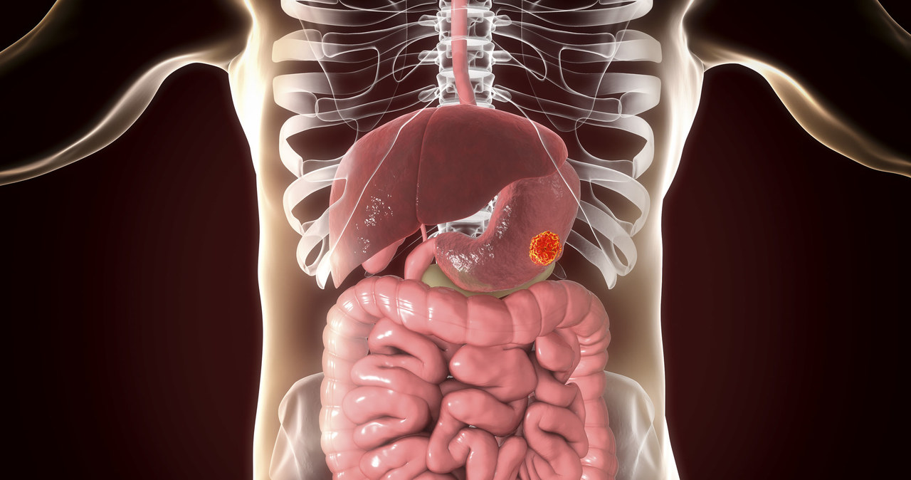 Co roku odnotowuje się około 5,6 tys. zgonów spowodowanych rakiem żołądka /123RF/PICSEL