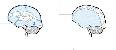 Co się dzieje z mózgiem podczas choroby Alzheimera? [INFOGRAFIKA]