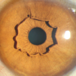 Co to za niezwykła struktura w oku?