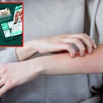 Co to za wysypka? Polscy naukowcy stworzyli wyjątkową aplikację