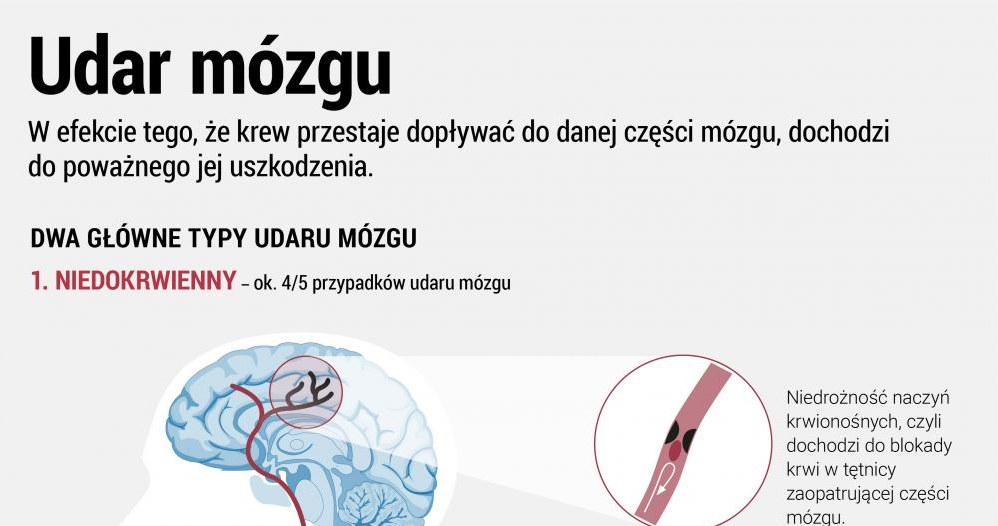 Co trzeba wiedzieć o udarze mózgu /www.zdrowie.pap.pl