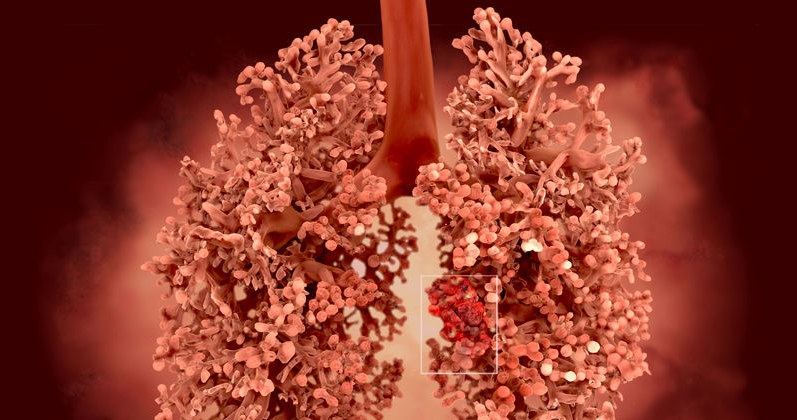 Co trzeci mężczyzna umierający na nowotwór w Polsce miał raka płuc /123RF/PICSEL