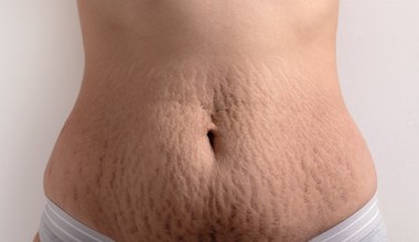Co wywołuje rozstępy i jak im przeciwdziałać?